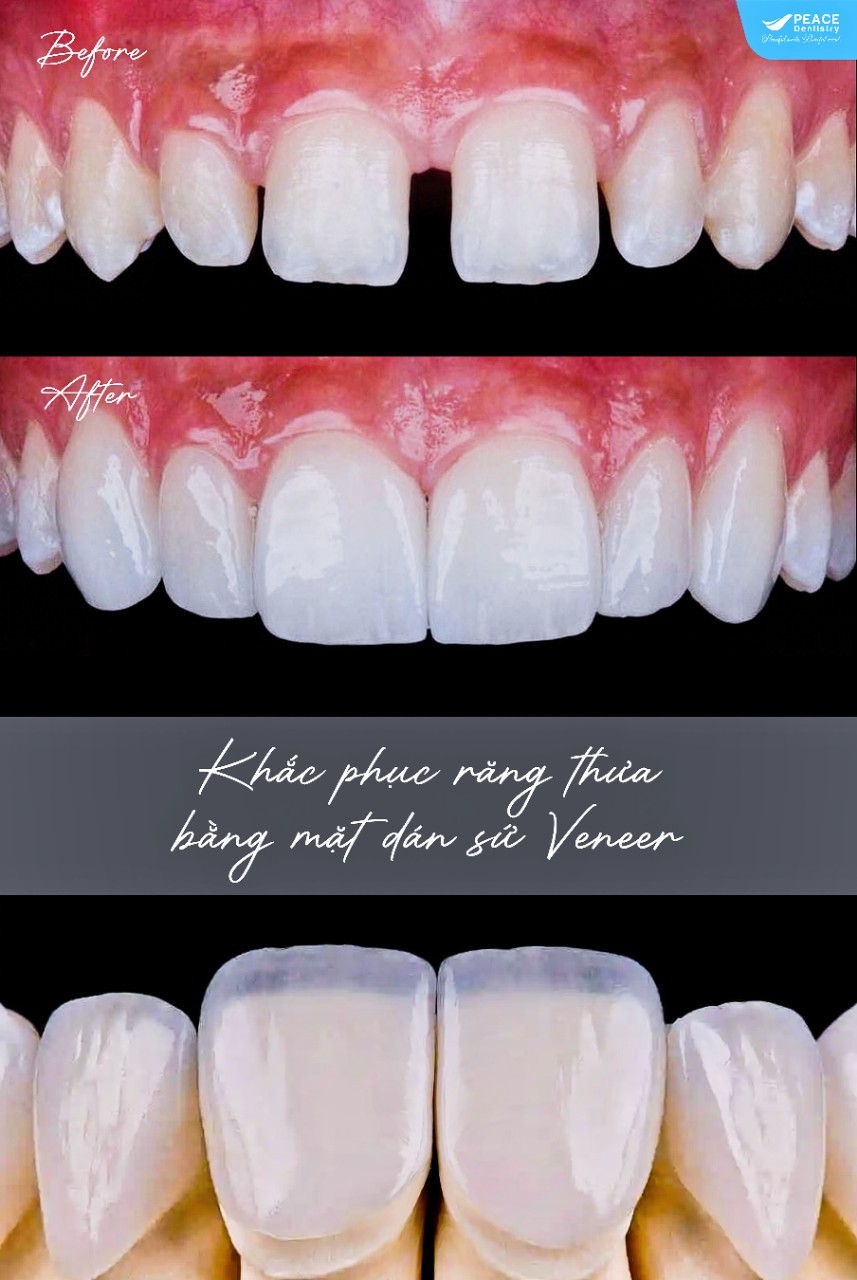 Ai là ứng viên lý tưởng để sử dụng phương pháp dán veneer để khắc phục răng thưa?