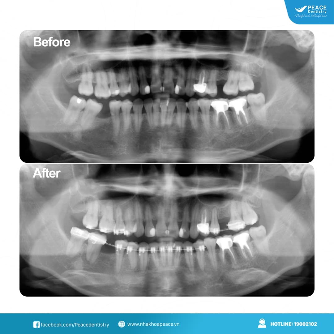niềng răng tạo khoảng để cấy ghép implant