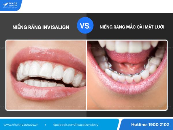 niềng răng invisalign và niềng răng mặt trong