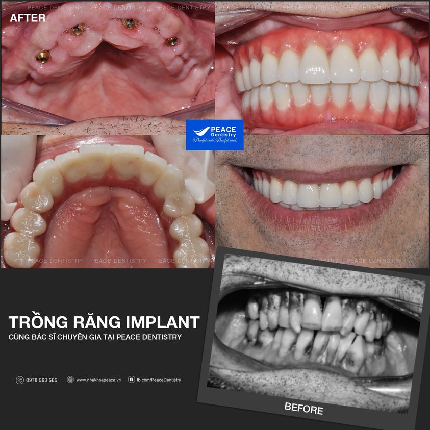 trồng răng implant all on 4 cho cả 2 hàm