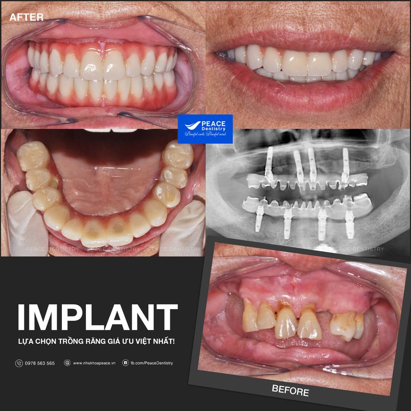 trồng răng implant toàn hàm ăn nhai thuận tiện