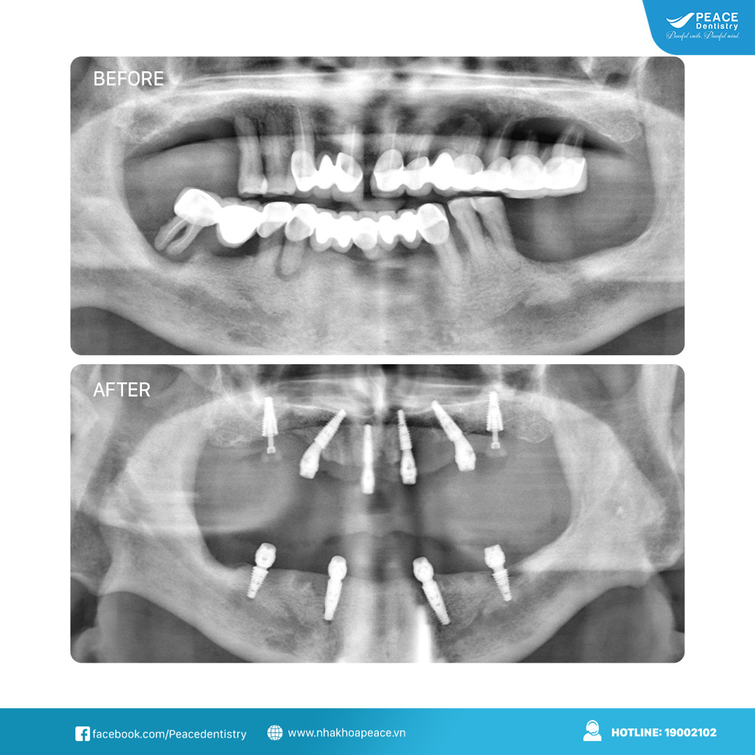 hình ảnh phim chụp trồng răng implant toàn hàm