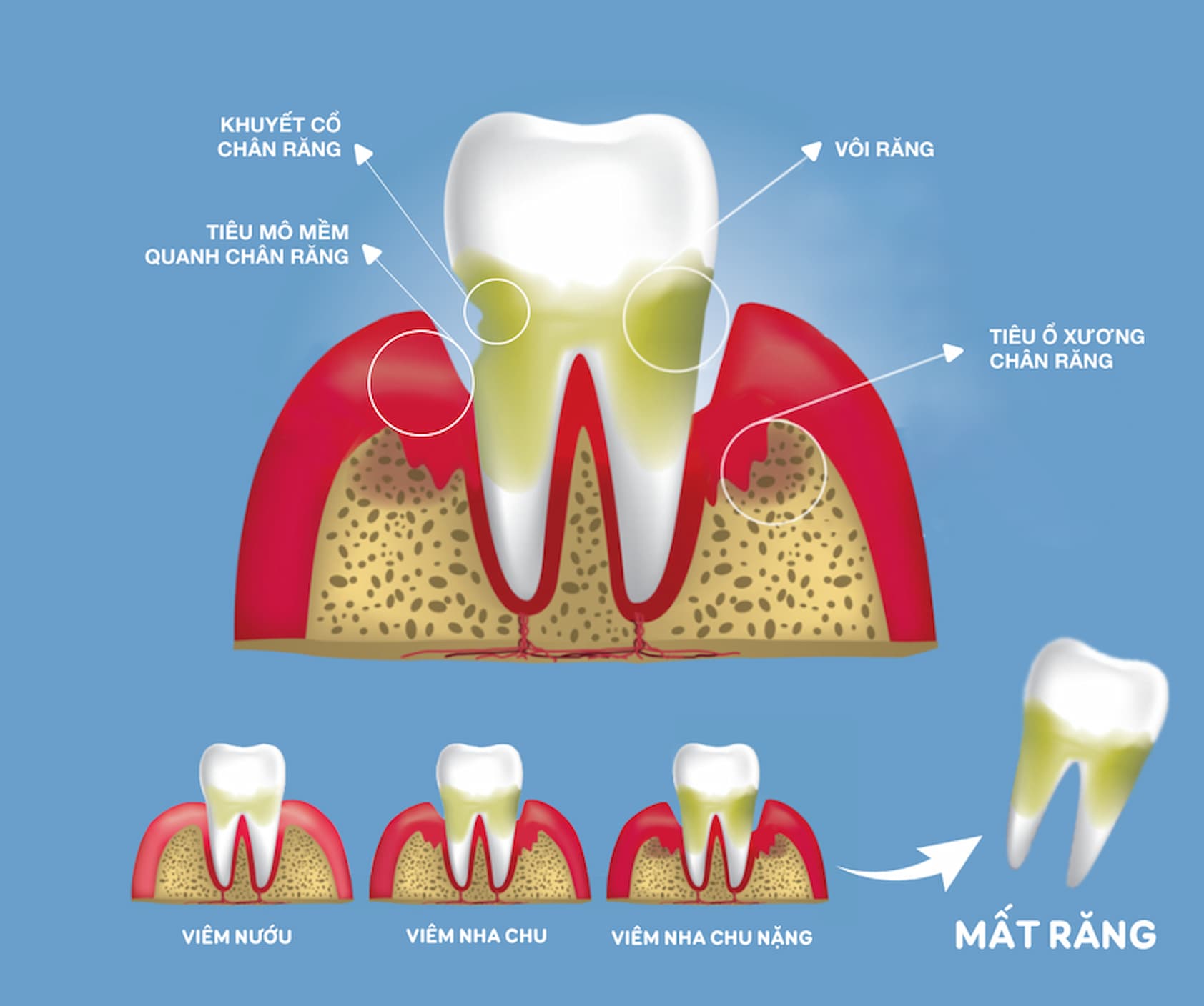 vôi răng dẫn đến chảy máu chân răng