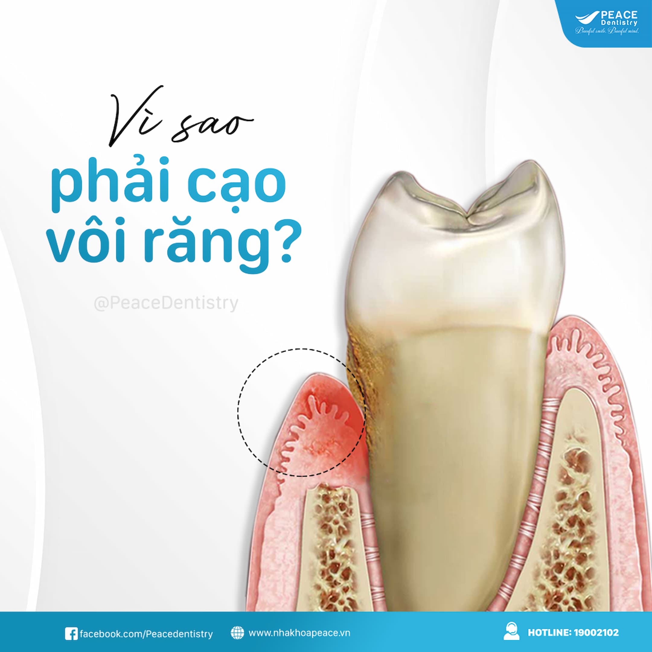 vôi răng là nguyên nhân gây ra viêm nướu