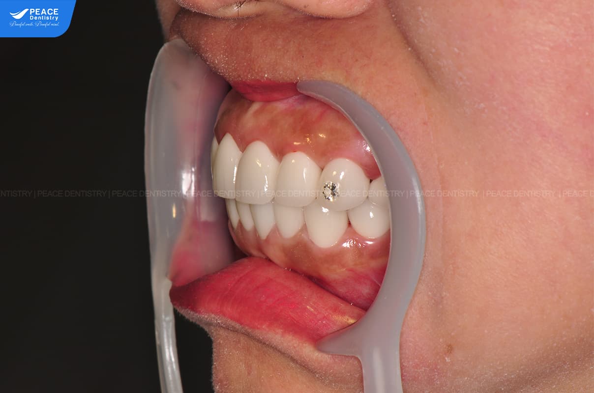 ca lâm sàng bọc răng sứ tại peace dentistry