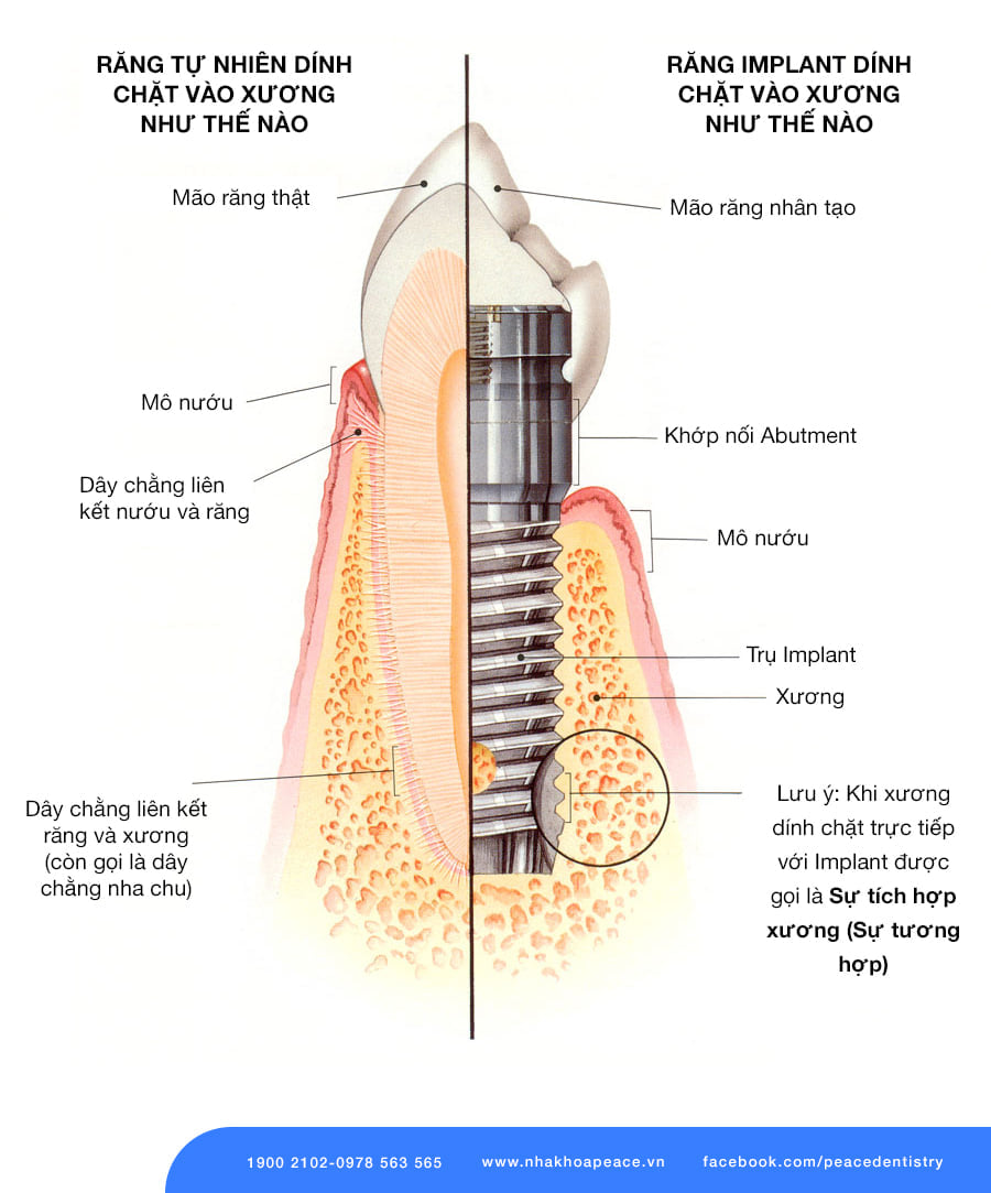 răng implant mang lại giá trị lý tưởng