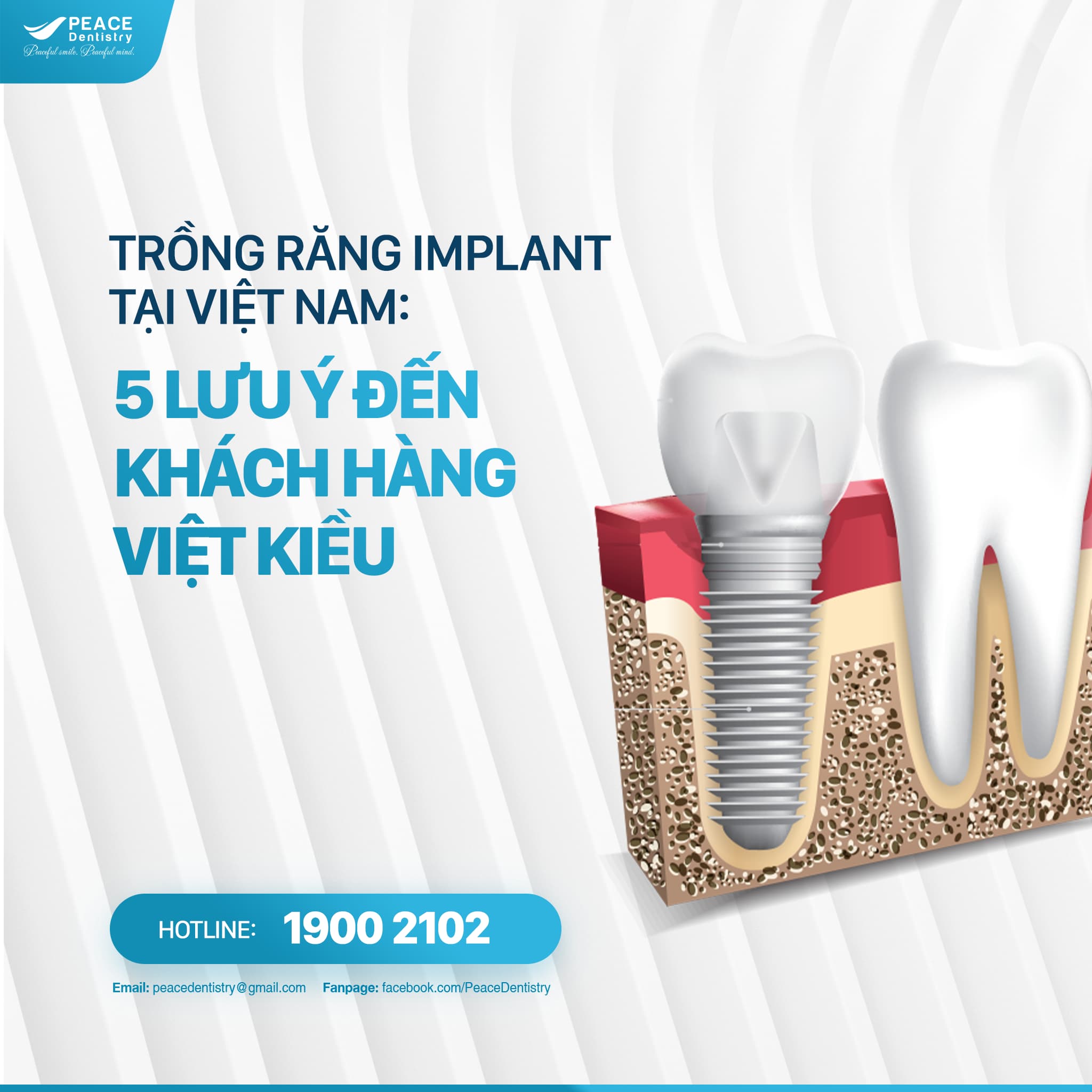 trồng răng implant tại việt nam 5 lưu ý khách hàng việt kiều cần biết