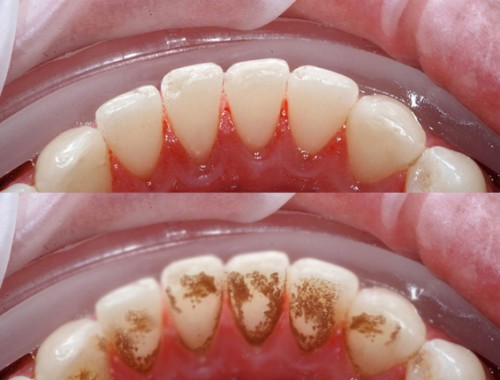 cạo vôi răng hạn chế chảy máu chân răng
