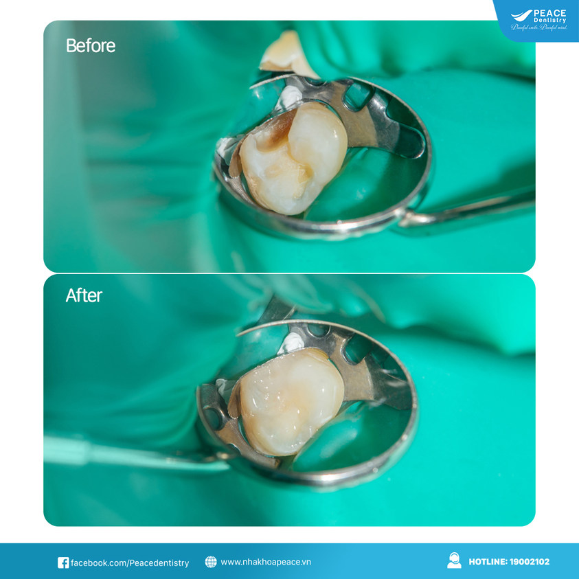 điều trị viêm tủy răng phục hồi bằng trám halogen quang trùng hợp