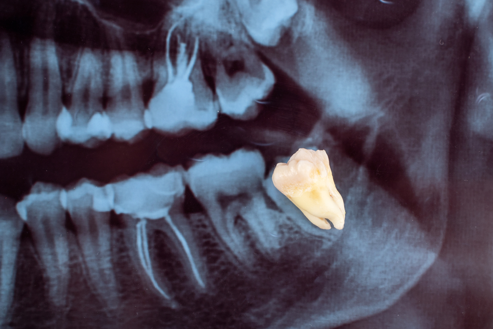 nhổ răng khôn tại nha khoa peace dentistry