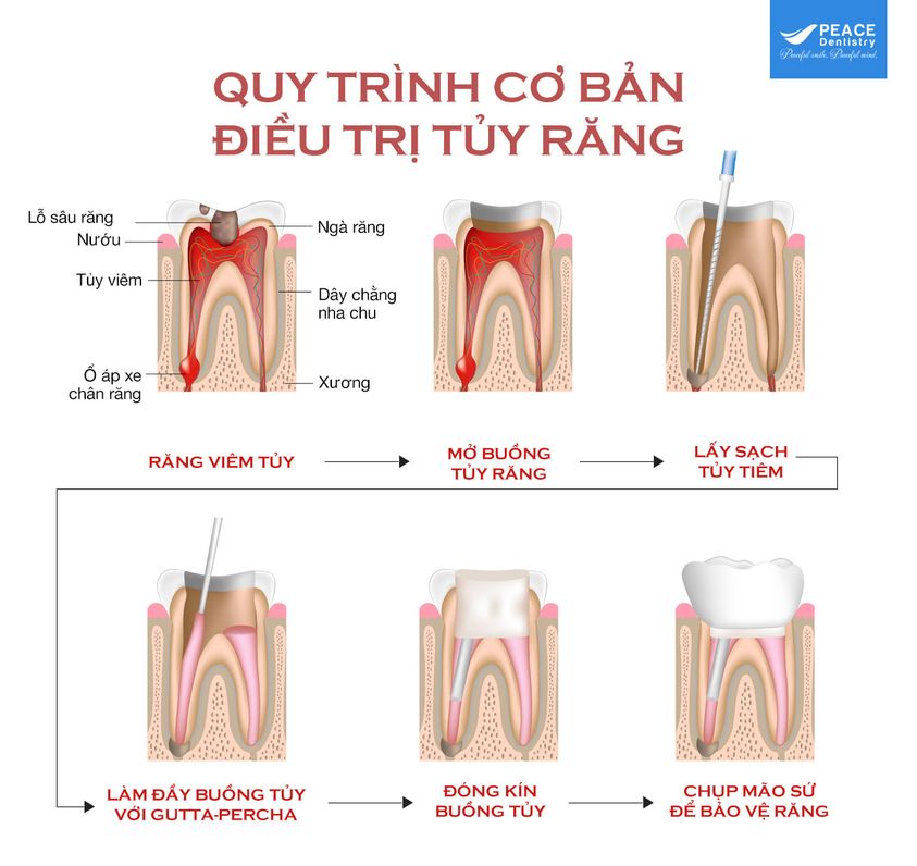 quy trình điều trị tủy răng tại Peace Dentistry
