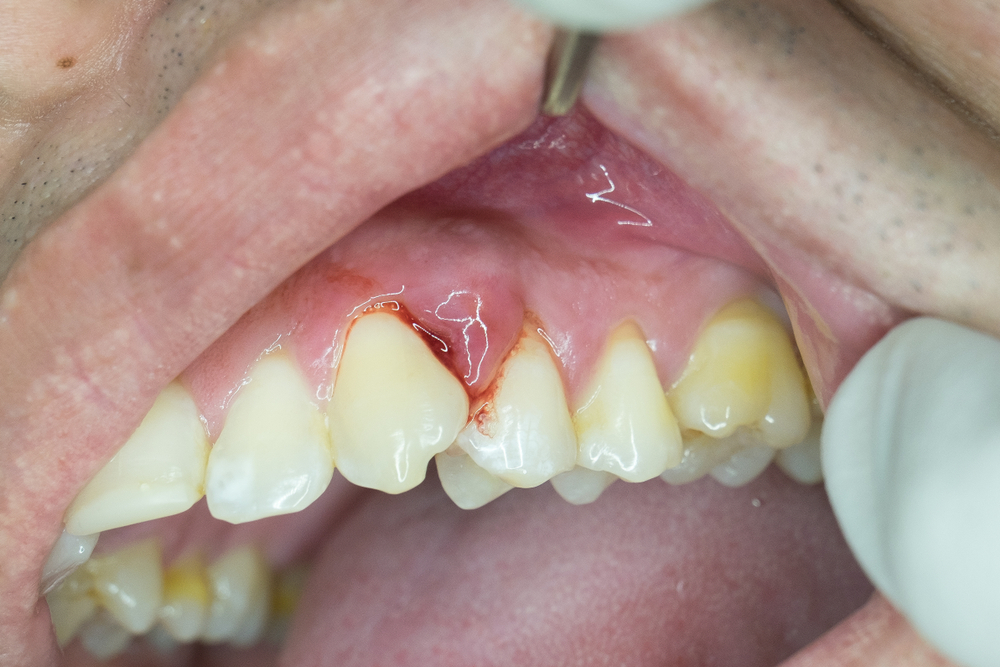 sưng nướu răng hàm trên hàm dưới