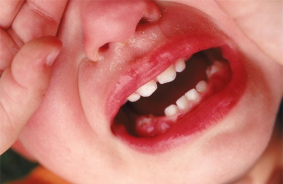 trẻ mọc răng