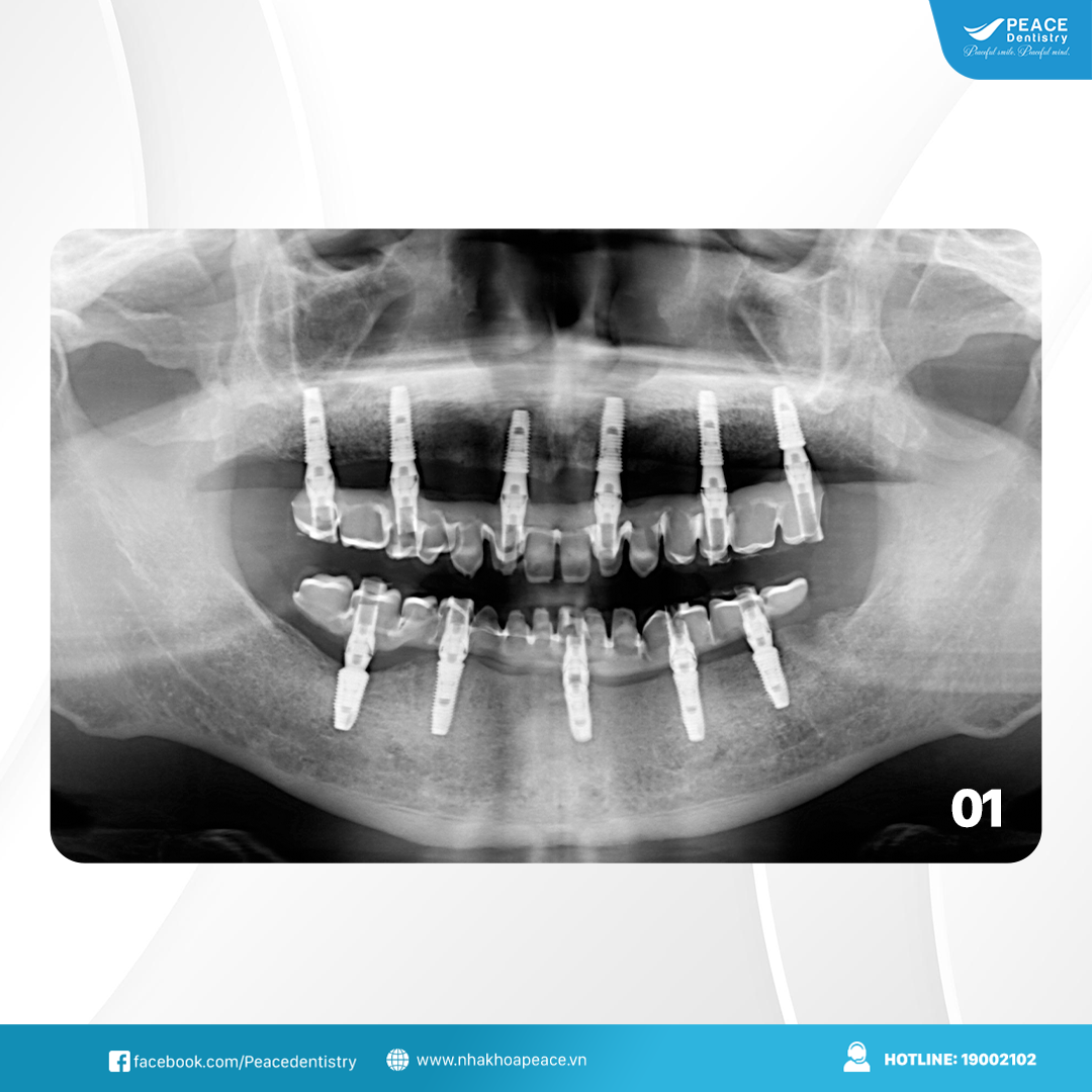 trồng răng implant all on 6 hàm trên all on 5 hàm dưới