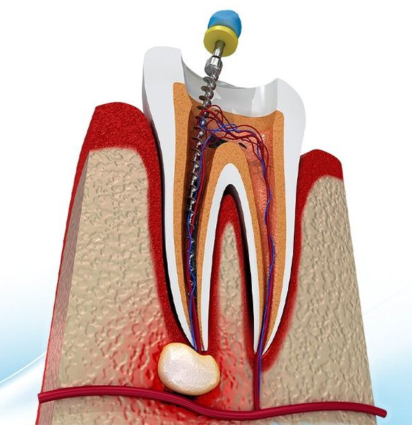 viêm tủy răng do không điều trị kịp thời