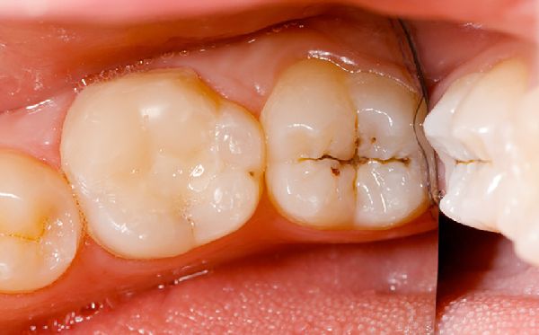 sâu răng nguyên nhân gây bệnh đau răng