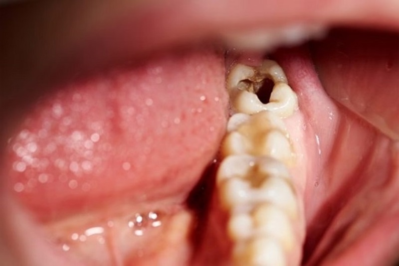 sâu răng gây viêm tủy
