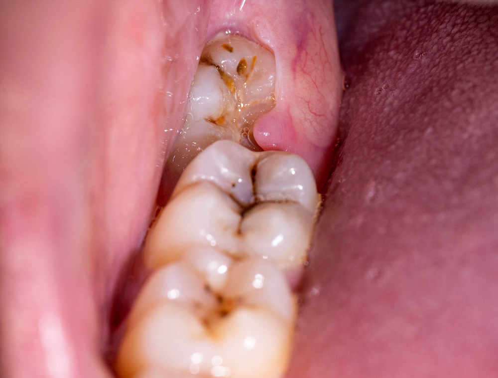 răng số 8 mọc lệch gây sưng nướu răng