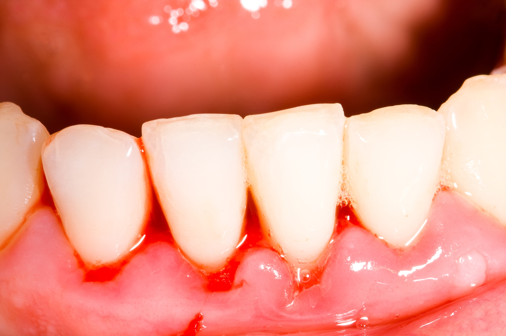 sưng nướu răng dẫn đến chảy máu chân răng tụt nướu