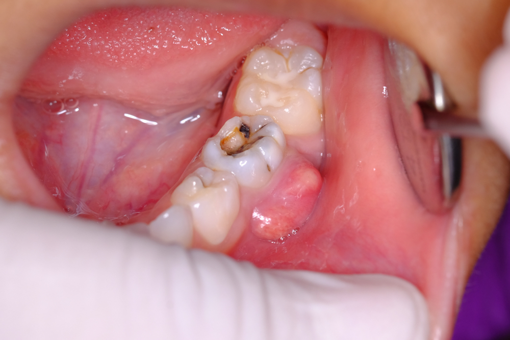 sưng nướu răng có mủ do viêm tủy