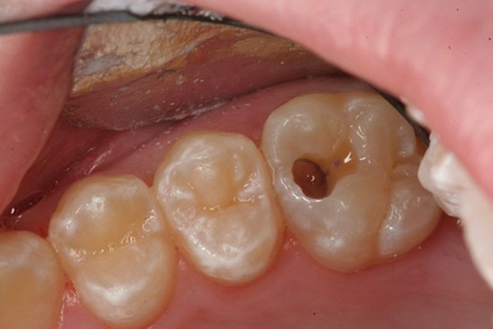 sưng nướu răng trong cùng do sâu răng