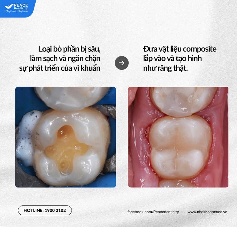 trám răng composite loại bỏ răng sâu
