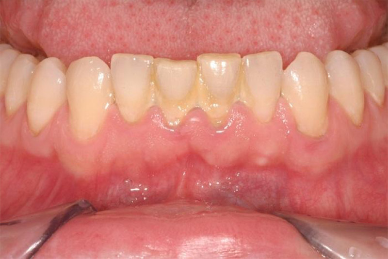vôi răng tích tụ dẫn đến sưng nướu