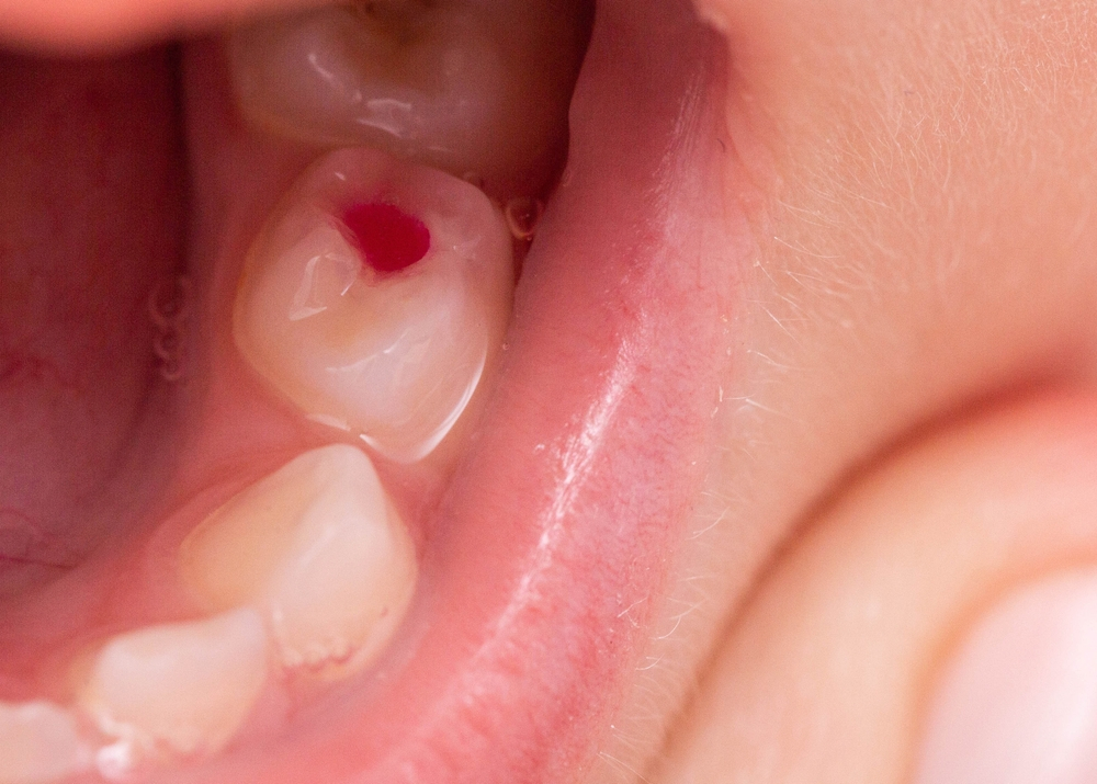 bé 3 tuổi bị sâu răng ảnh hưởng đến tủy