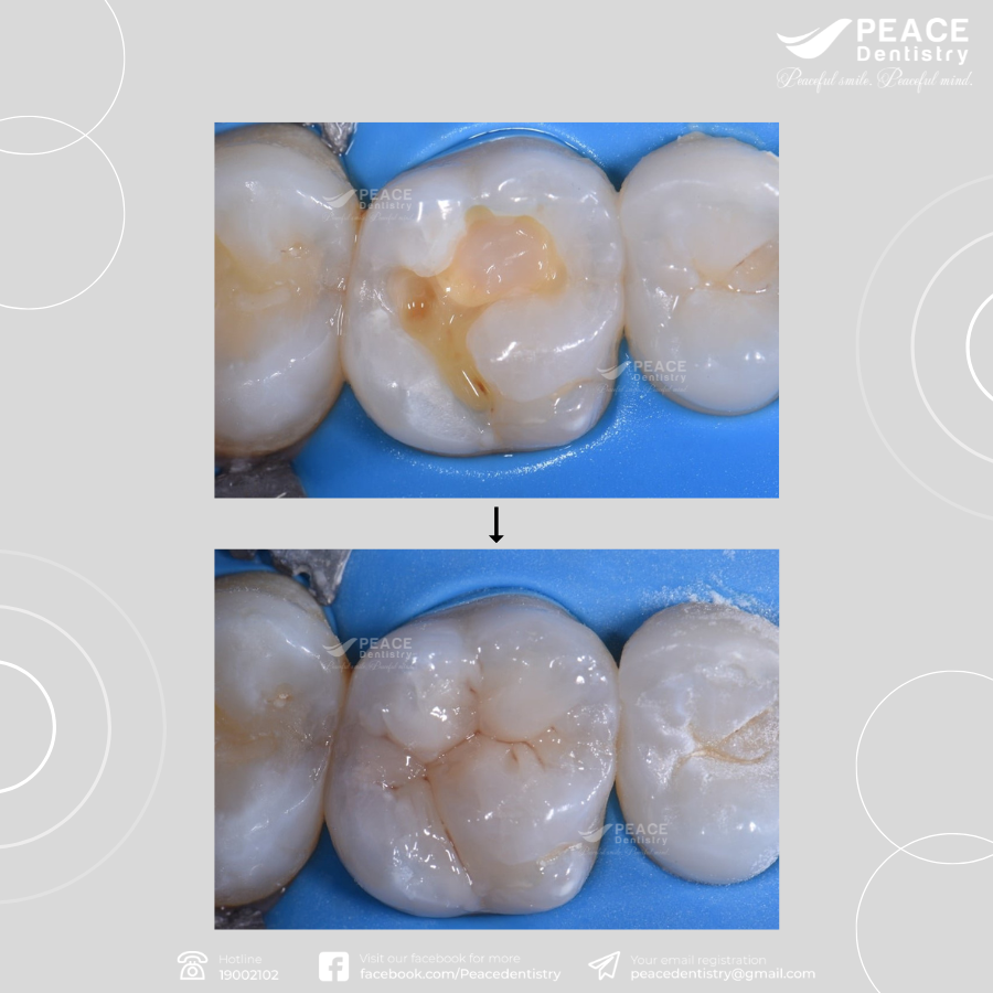 trám răng phục hồi răng cho trẻ bị sâu răng