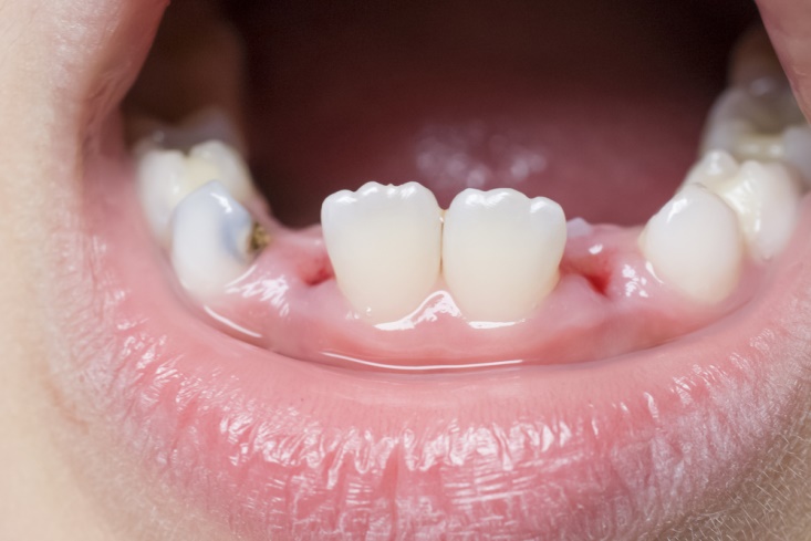nhổ răng trẻ em tại peace dentistry