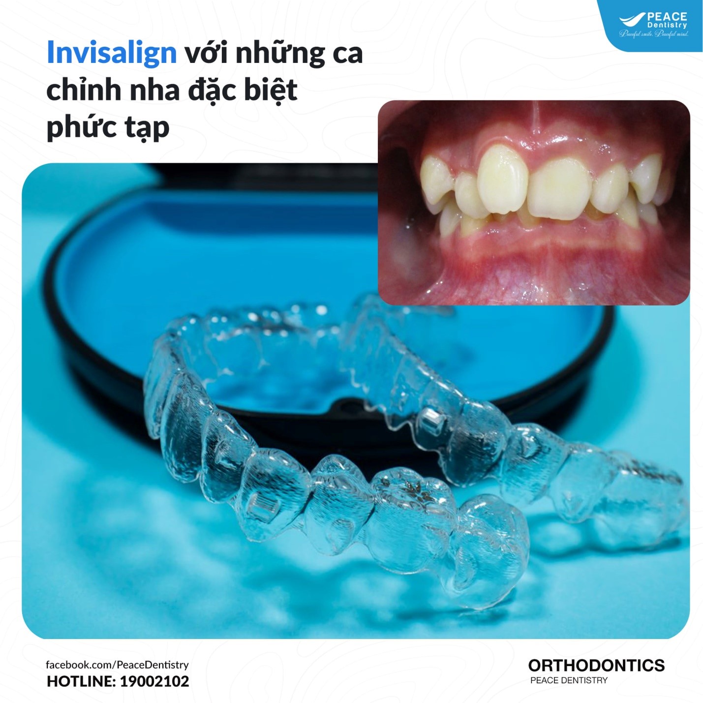 niềng răng Invisalign can thiệp kịp thời cho trẻ bị hô xương hàm