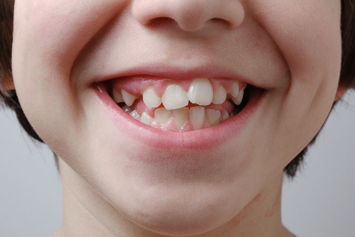 răng bị lòi xỉ gây lệch khớp cắn