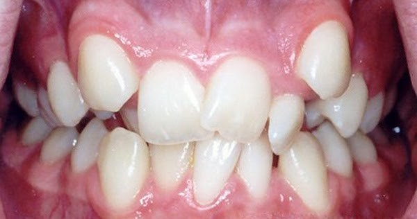 khách hàng điều trị răng lòi xỉ tại peace dentistry
