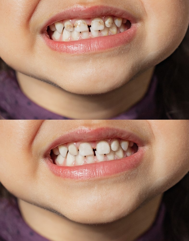 tái khoáng men răng cho trẻ bị sâu răng