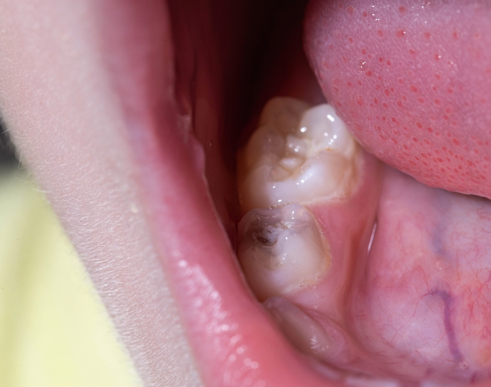 trẻ men răng yếu gây sâu răng