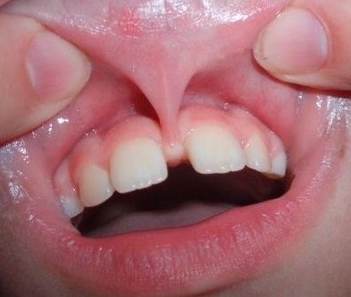răng cửa bị thưa do dây nối lưỡi phát triển quá mức