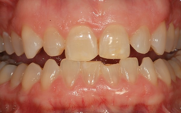 răng trẻ bị vàng do nhiễm Tetracyline