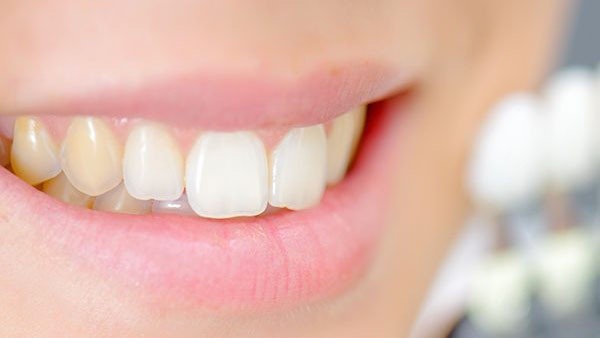 răng vĩnh viễn bị vàng do di truyền