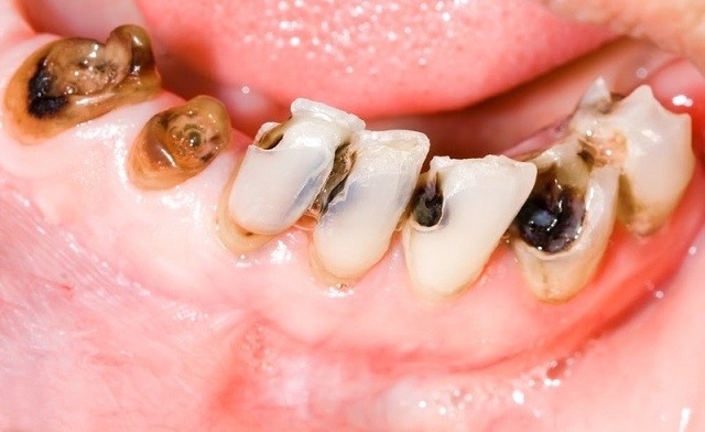 sâu răng làm răng bị đen
