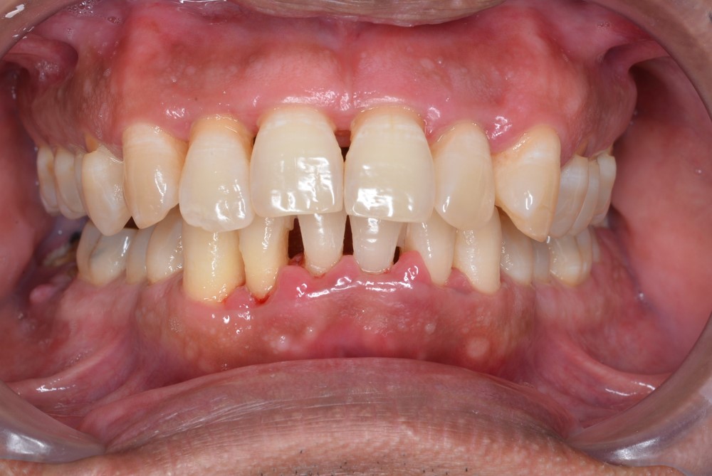 viêm nha chu khiến răng vĩnh viễn của trẻ bị lung lay