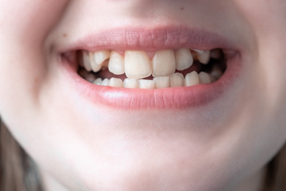 trẻ nghiến răng gây lệch khớp cắn