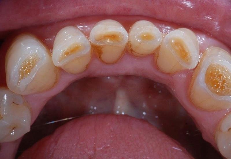 nghiến răng dẫn đến mòn răng ở trẻ