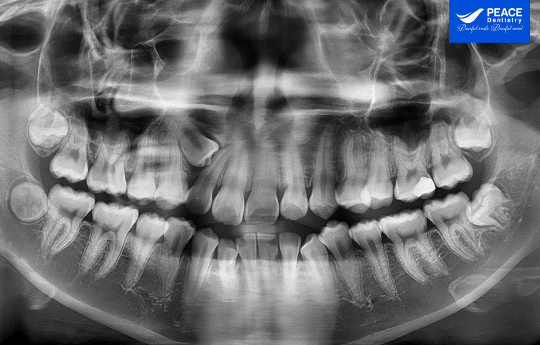 răng số 3 mọc ngầm gây rối loank khớp cắn
