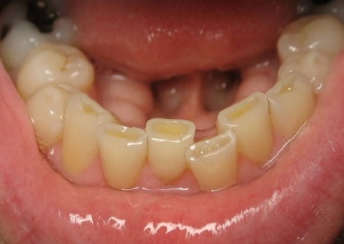 trẻ hay nghiến răng khiến răng bị mòn