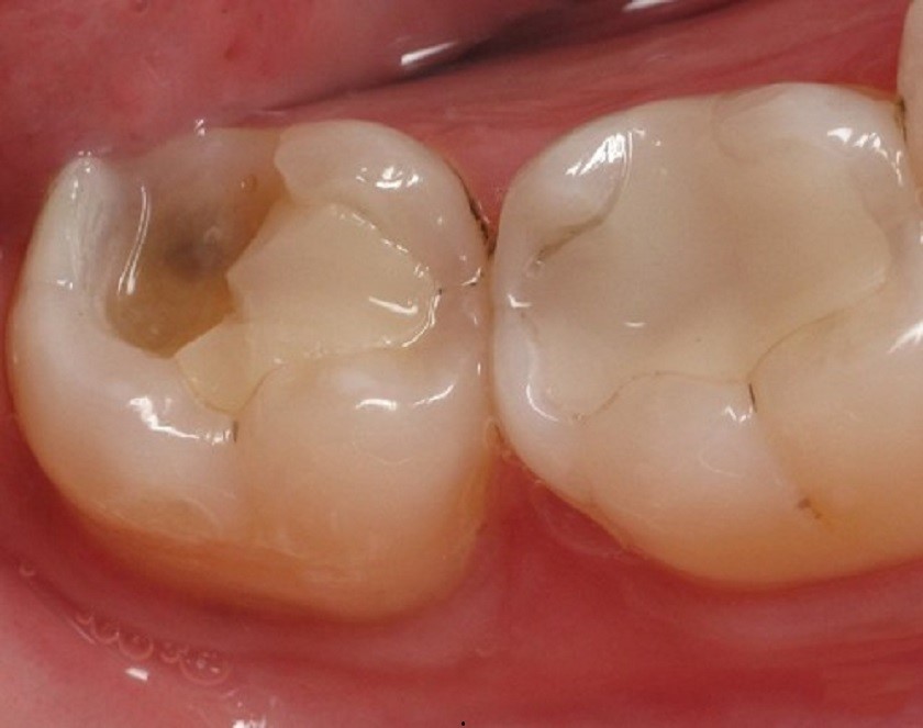 trám răng sai kỹ thuật tăng nguy cơ sâu răng