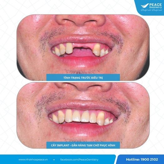trồng răng implant khắc phục răng sâu