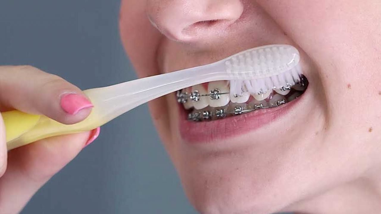 niềng răng dùng bàn chải gì