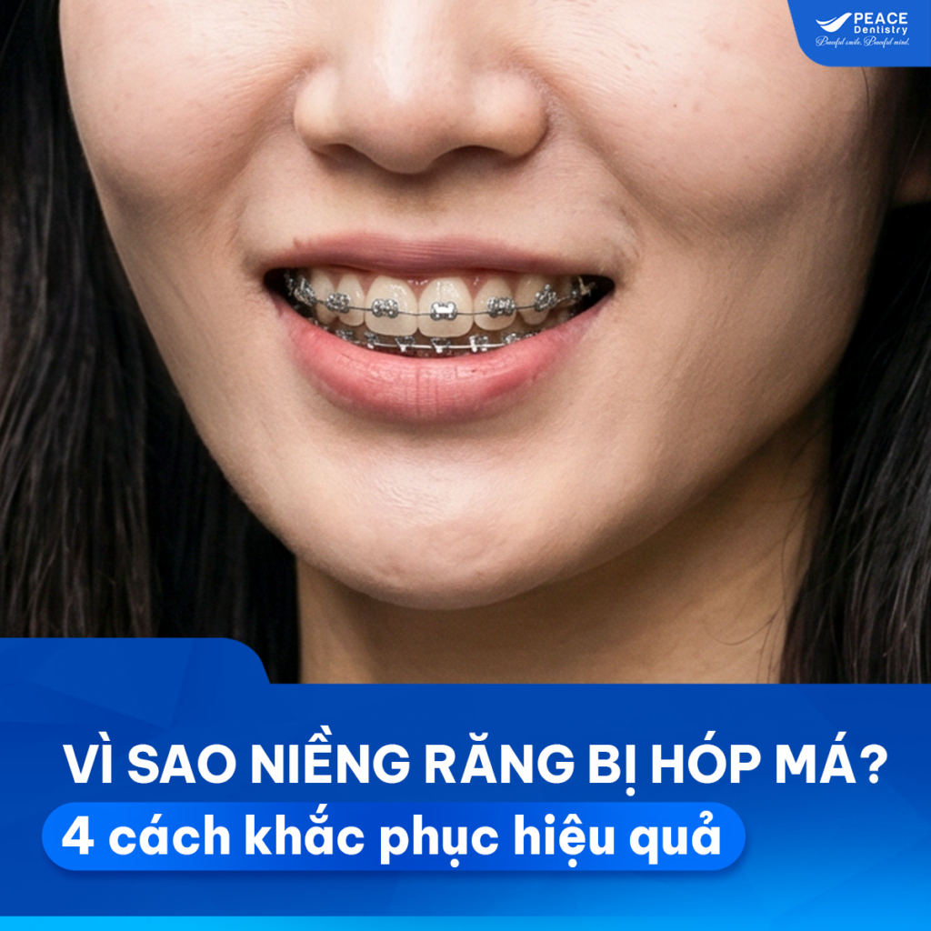 niềng răng có bị hóp má không