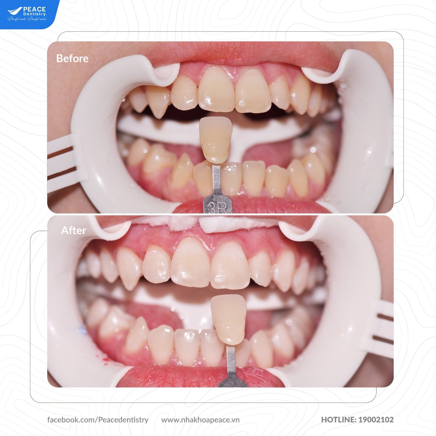 hình ảnh tẩy trắng răng tại peace dentistry