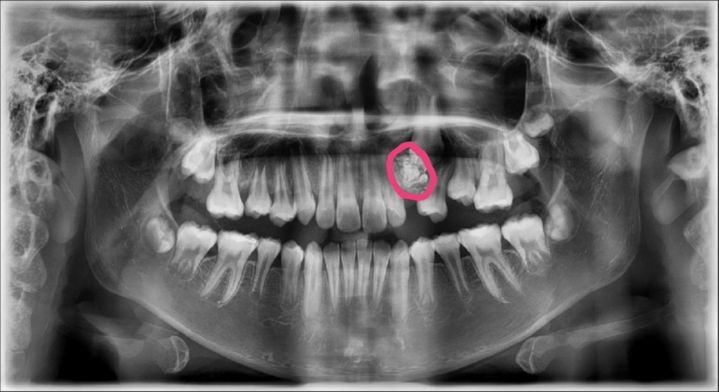 biến chứng do áp xe răng gây ra